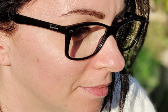 Before and after photos showing the results of PicoWay Resolve treatment on acne scars, pigmentation, and fine lines at Skin Revive Clinic.